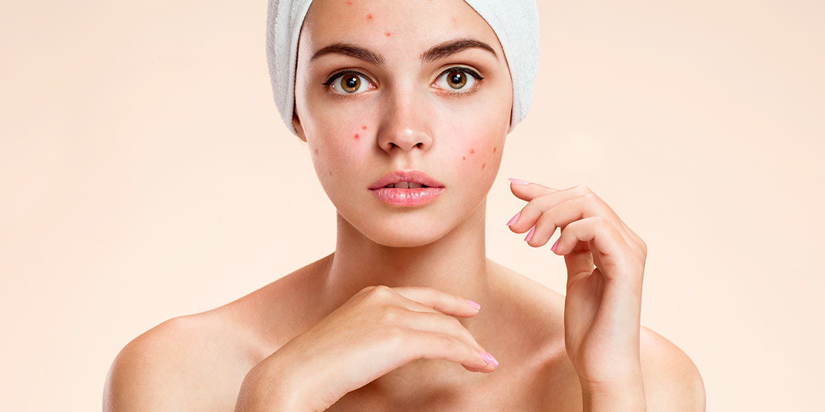 TRATAMIENTOS ¿Sabías que el acné afecta al 85% de los jóvenes?